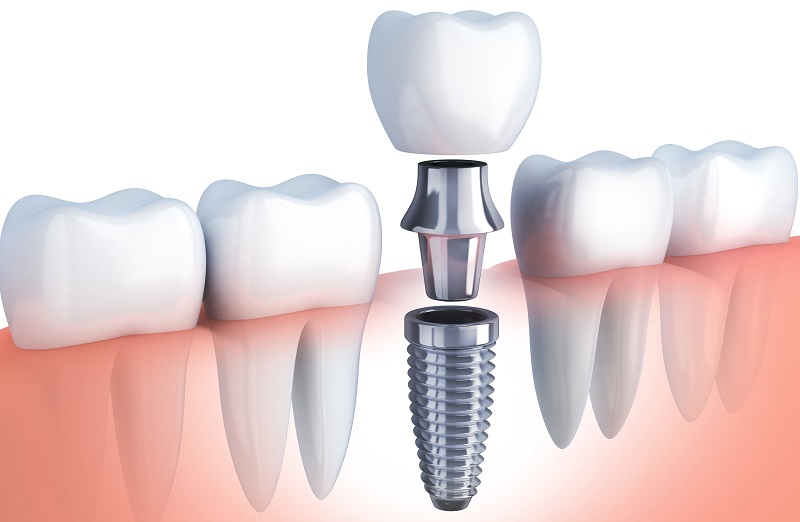 خطر عوارض کاشت ایمپلنت دندان