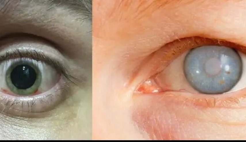 وزارت بهداشت نوار غزه : هزاران نفر با خطر نابینایی قرار دارند